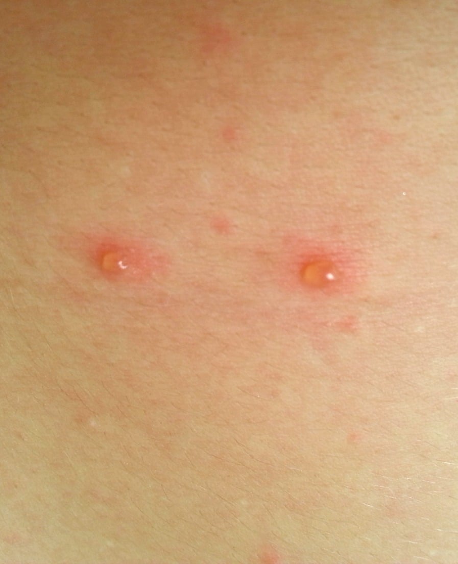 What Does Chicken Pox Look Like Starting Out