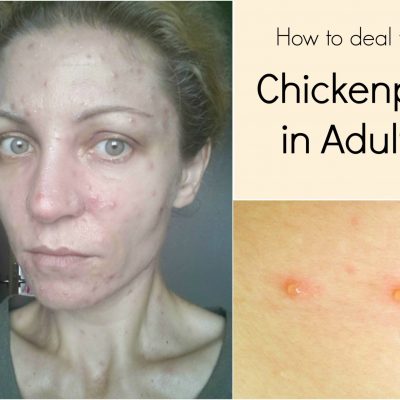 How to deal with chickenpox in adults