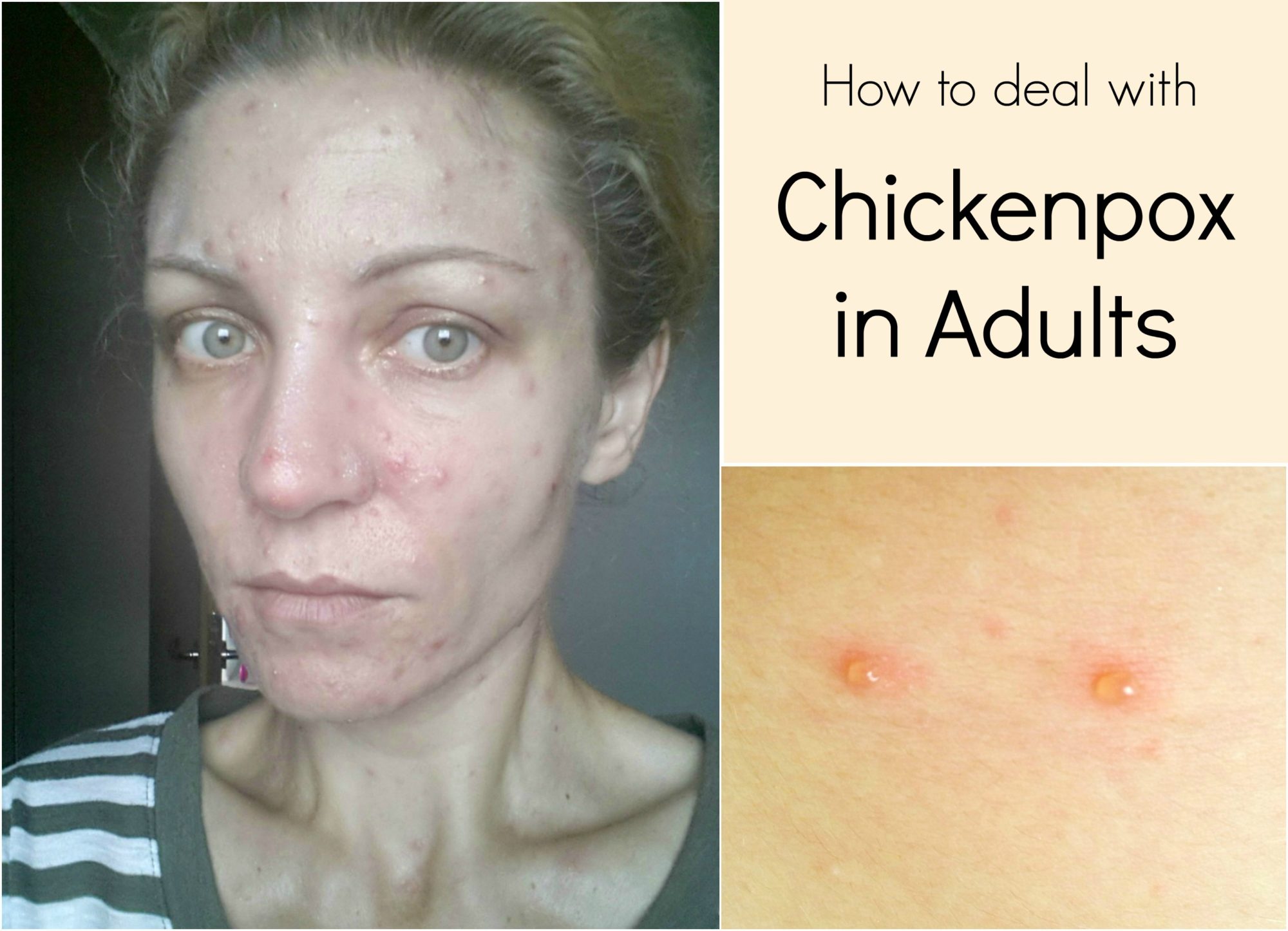 How to deal with chickenpox in adults - The Seaman Mom