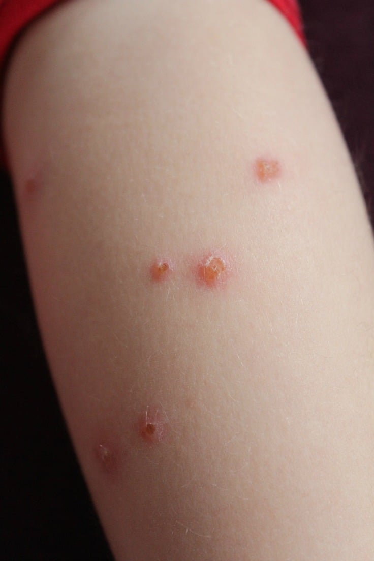 Flea bites